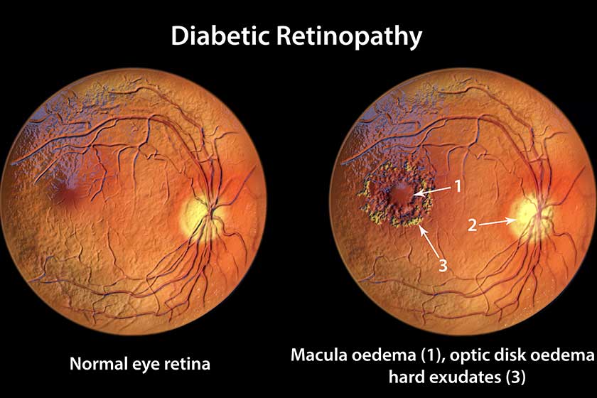 Diabetic retinopathy, 3D illustration showing macula edema, optic disk edema and hard exudates, abnormal finding on fundoscopic examination of the eye retina in diabetes mellitus